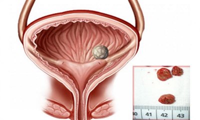 Камни мочевого пузыря: симптомы и причины